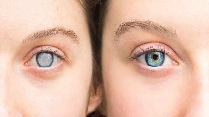 ما هو السادّ (الماء الأبيض)؟